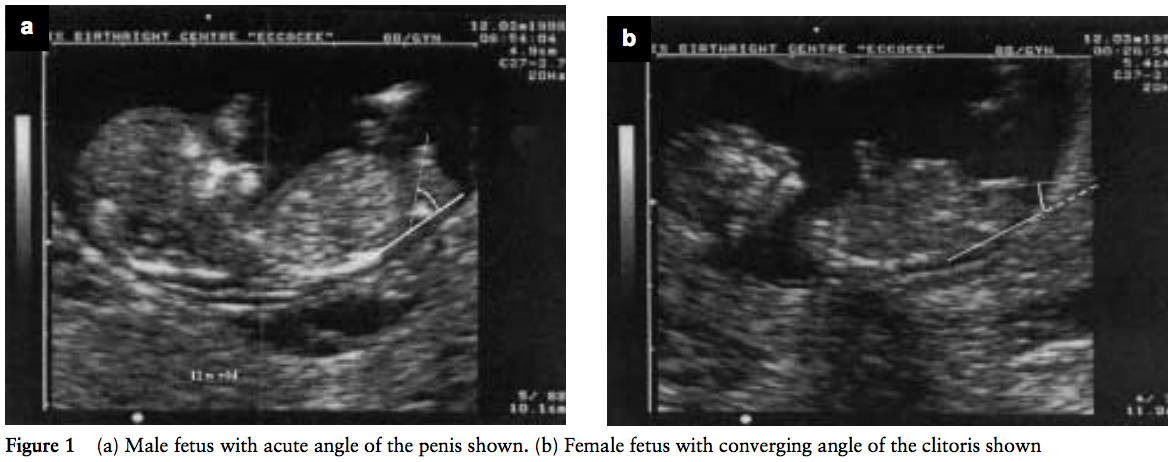 How to find the baby is boy or girl during pregnancy